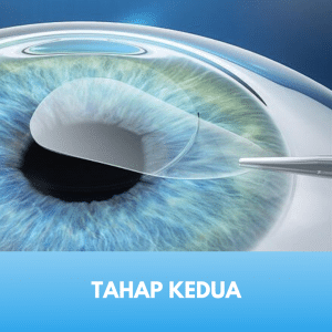 prosedur lasik