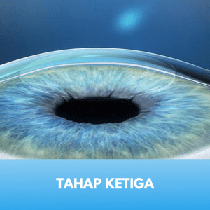 prosedur lasik