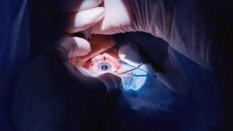 Mengenal Persamaan Lasik Mata dan Operasi Katarak